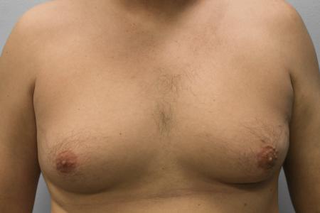 Before image 1 Case #108141 - Gynecomastia