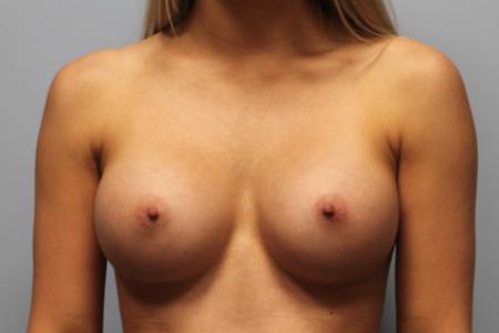 After image 1 Case #108196 - Breast Augmentation