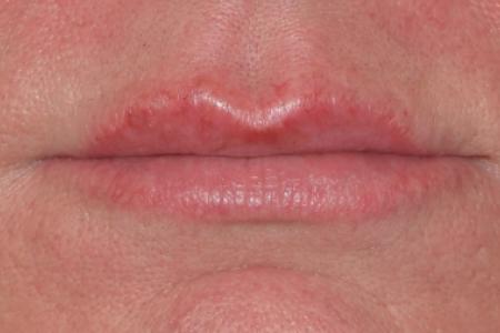 After image 1 Case #107926 - Restylane® Dermal Fillers