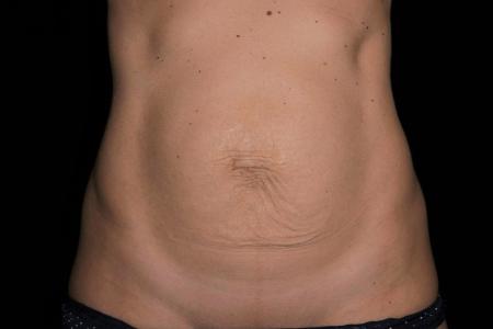 Before image 1 Case #107896 - Abdominoplasty with Muscle Plication/Hernia Repair