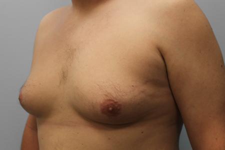 Before image 2 Case #108141 - Gynecomastia