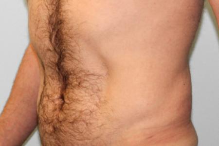 After image 2 Case #107556 - SmartLipo