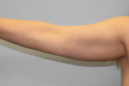 Before image 1 Case #108156 - Arm Lipo