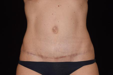 After image 1 Case #107896 - Abdominoplasty with Muscle Plication/Hernia Repair