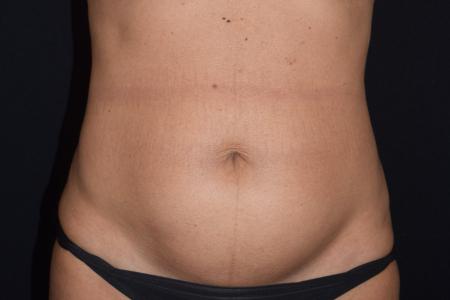 Before image 1 Case #107886 - Female Liposuction & Fat Transfer