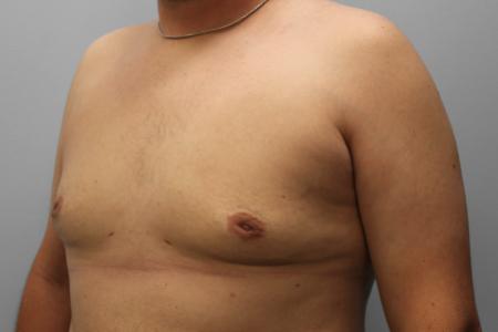 After image 2 Case #108141 - Gynecomastia