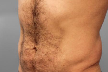 Before image 2 Case #107556 - SmartLipo