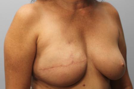 After image 2 Case #108046 - Breast Reconstruction