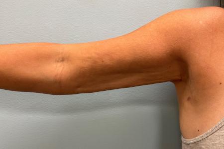 After image 1 Case #108156 - Arm Lipo