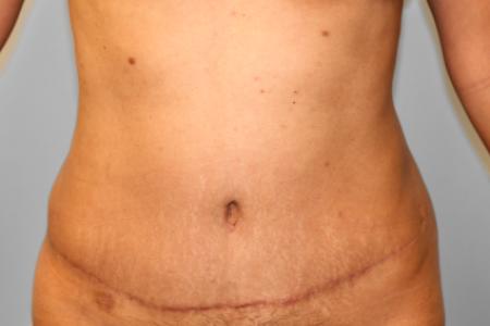 After image 1 Case #108036 - Tummy Tuck