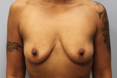 Before image 1 Case #107526 - Mommy Makeover