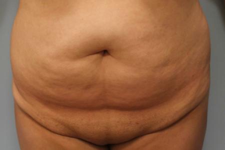 Before image 1 Case #108111 - Tummy Tuck & BBL