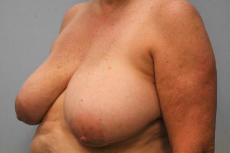 Before image 2 Case #107816 - Breast Reconstruction