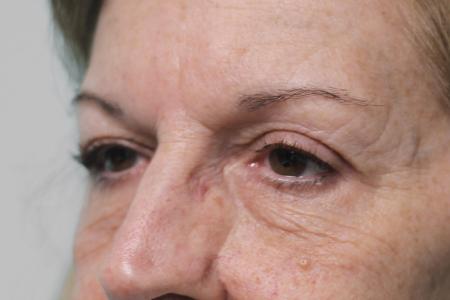 After image 2 Case #107966 - Blepharoplasty