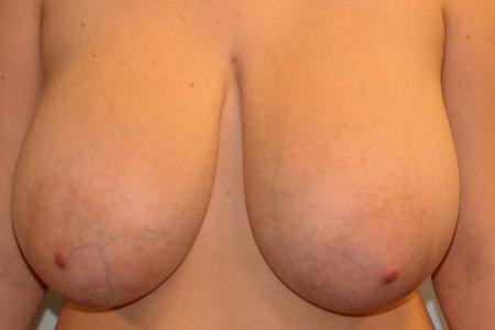 Before image 1 Case #108101 - Breast Reduction