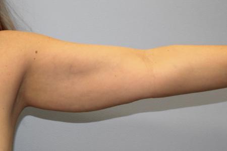 Before image 2 Case #108156 - Arm Lipo