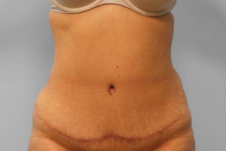 After image 1 Case #108076 - Tummy Tuck