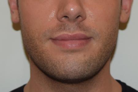 After image 1 Case #107881 - Male Facial Contouring with Morpheus8