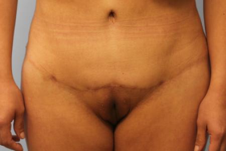 After image 1 Case #108111 - Tummy Tuck & BBL