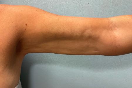 After image 2 Case #108156 - Arm Lipo