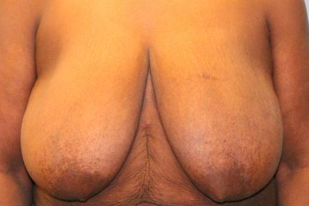 Before image 1 Case #108256 - Breast Reduction