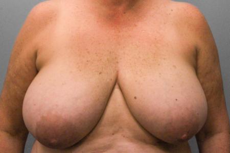 Before image 1 Case #107816 - Breast Reconstruction