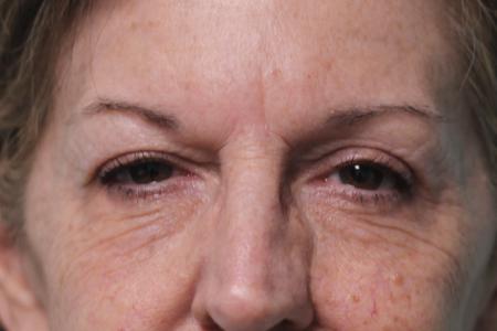 After image 1 Case #107966 - Blepharoplasty