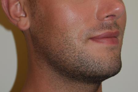 Before image 3 Case #107881 - Male Facial Contouring with Morpheus8