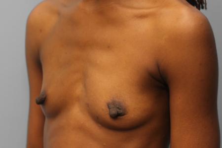 Before image 2 Case #108096 - Breast Augmentation