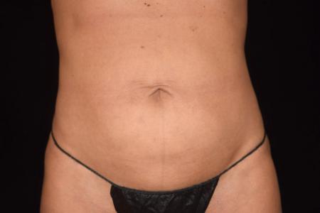 After image 1 Case #107886 - Female Liposuction & Fat Transfer