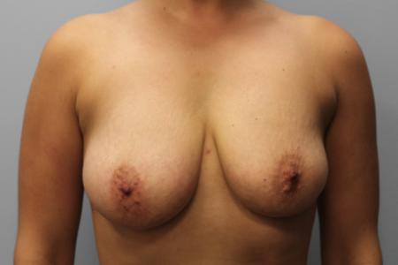 Before image 1 Case #107586 - Breast Augmentation