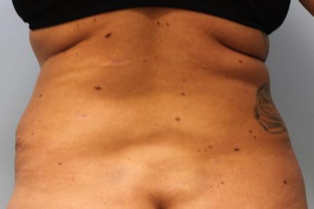 After image 4 Case #108051 - Tummy Tuck
