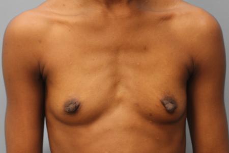 Before image 1 Case #108096 - Breast Augmentation