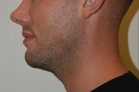 Before image 2 Case #107881 - Male Facial Contouring with Morpheus8