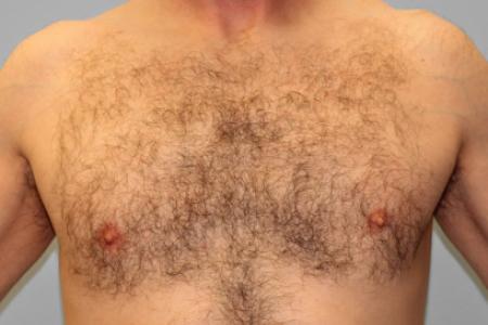 After image 1 Case #107556 - SmartLipo