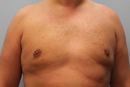 After image 1 Case #107721 - Gynecomastia Sugery