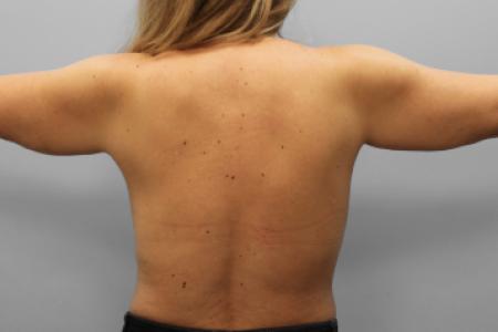 Before image 3 Case #108156 - Arm Lipo