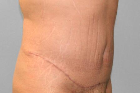 After image 2 Case #107676 - Tummy Tuck