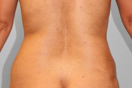 After image 4 Case #108036 - Tummy Tuck