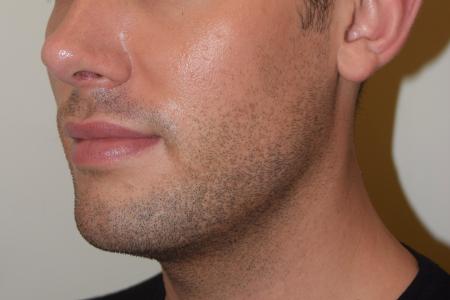 After image 4 Case #107881 - Male Facial Contouring with Morpheus8