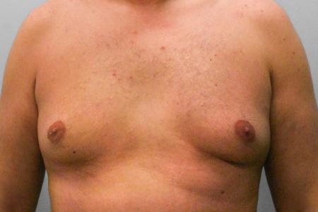 Before image 1 Case #107721 - Gynecomastia Sugery