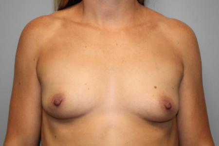 Before image 1 Case #107986 - Breast Augmentation