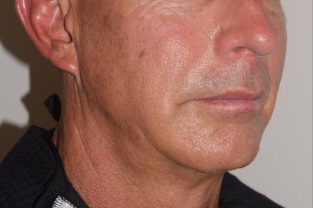 After image 1 Case #107876 - Male Facial Contouring