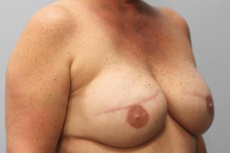 After image 2 Case #107961 - Breast Reconstruction