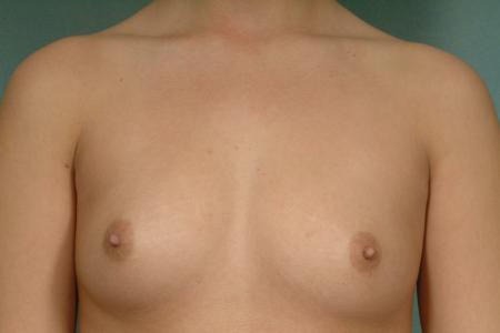 Before image 1 Case #107501 - Breast Augmentation