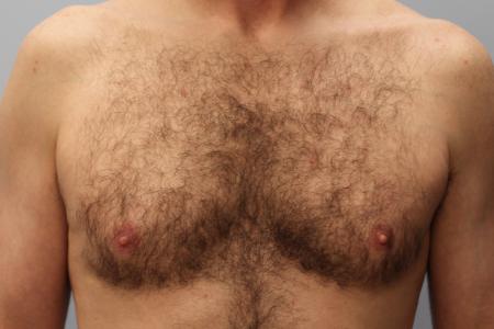 Before image 1 Case #107556 - SmartLipo