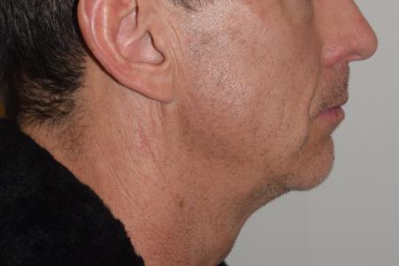 Before image 3 Case #107876 - Male Facial Contouring
