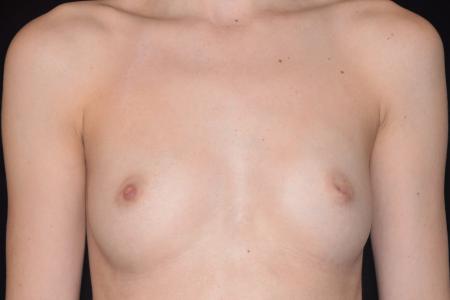Before image 1 Case #107901 - Underarm Endoscopic Breast Augmentation