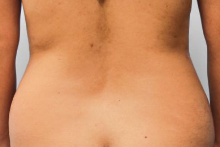 Before image 4 Case #108036 - Tummy Tuck