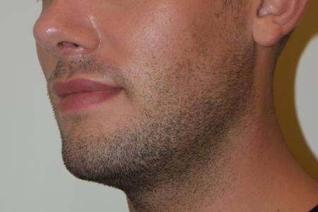 Before image 4 Case #107881 - Male Facial Contouring with Morpheus8